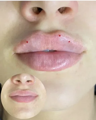 Отзыв о Увеличение губ препаратом Juviderm Ultra 3 | Знаменитая форма губ  Эмильяна Брауде техника ТП. Красиво или уродство?