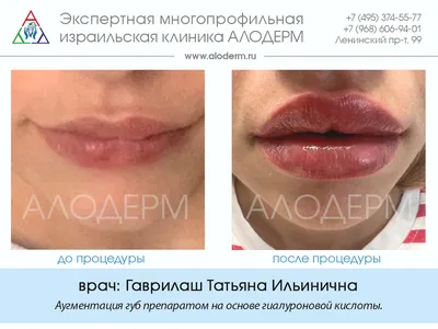 Пластика губ, модные тренды - АллергоЦентр Новороссийск