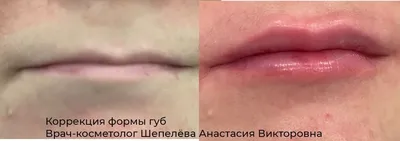 Красивые губы - осуществимая мечта 😍 ⠀ На фото - результат коррекции формы  губ препаратом Juvederm Volift 1 мл ⠀ ❗️Beautyme! напоминает… | Instagram