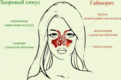 Как отличить гайморит от насморка. Симптомы и лечения синусита