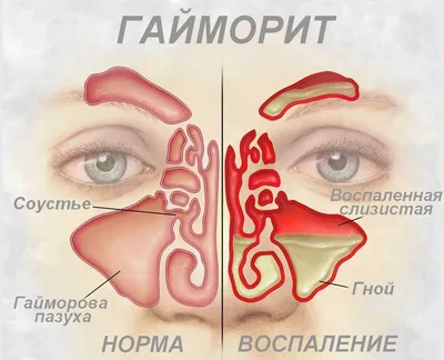 Крапивой по носу. Как молодая крапива помогла маме от гайморита. | Кирилл |  Дзен