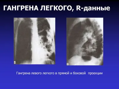 Специфические хирургические инфекции: газовая гангрена, столбняк, сибирская  язва. Лекция для врачей. - YouTube