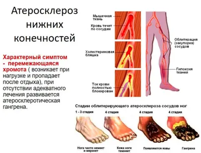 Гангрена - причины, симптомы, признаки, диагностика, лечение, прогноз,  профилактика