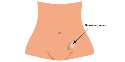 Воспаление лимфоузлов в паху у женщин: причины, лечение» — Яндекс Кью