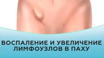 Воспаление и увеличение лимфоузлов в паху - YouTube