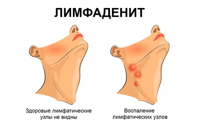 15 сентября – Всемирный день борьбы с лимфомами