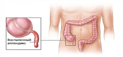 Где находится аппендицит картинка фотографии