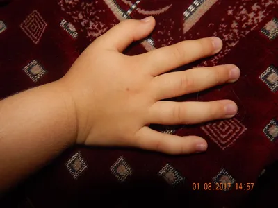 Изображение гемангиомы на руке на темном фоне
