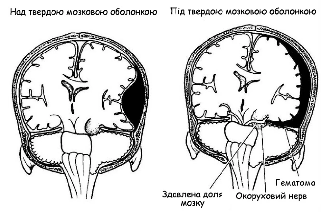 Черепно мозговые гематомы. Конвекситальная субдуральная гематома. Субдуральные и эпидуральные гематомы на кт. Черепно-мозговая гематома субдуральная. Эпидуральная гематома головного мозга на кт.