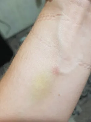 Картинка гематомы на руке: как быстро восстановиться