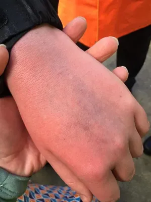 Подробное фото гематомы на руке