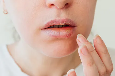 Герпес на губе и другие типы герпетической инфекции