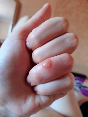 Картинка герпеса на пальцах рук: какие существуют методы уменьшения интенсивности симптомов