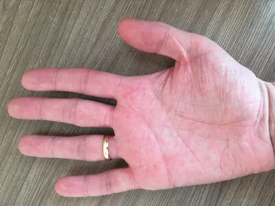 Фото герпеса на пальцах рук в формате WebP