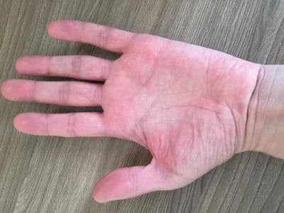 Фотка герпеса на пальцах рук: как быстро вылечиться