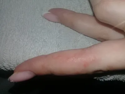 Фото герпеса на пальцах рук: как быстро облегчить симптомы