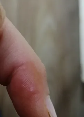 Герпес на пальце руки: острая фотография в формате JPG