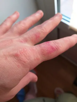 Фото герпеса на пальце руки: натуральные цвета