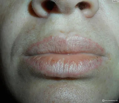 Герпес после татуажа губ: изображение с информацией о рисках