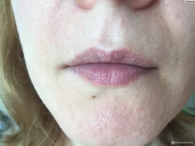 Изображение герпеса после татуажа губ: как лечить