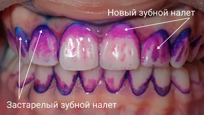 Профессиональная гигиена полости рта у детей в Москве | АктивСтом