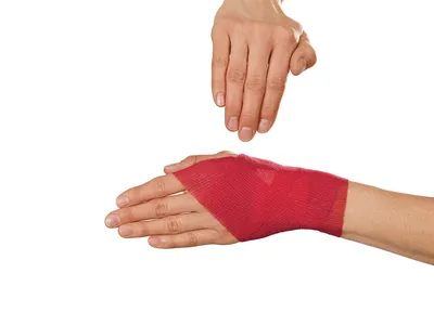 Гигрома кисти руки: фото после операции