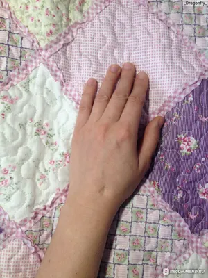 Картинка гигромы на кисти руки с описанием