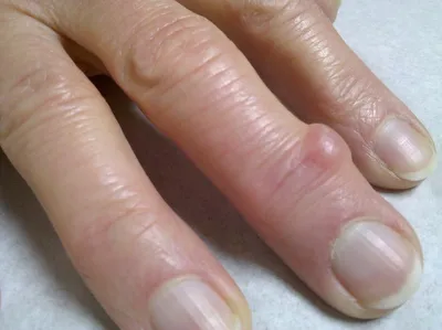 Изображение гигромы на кисти руки в процессе лечения