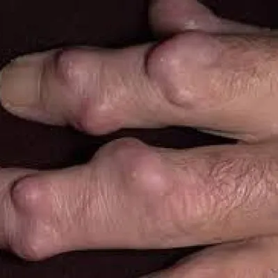 Изображение гигромы на кисти руки - причины и профилактика