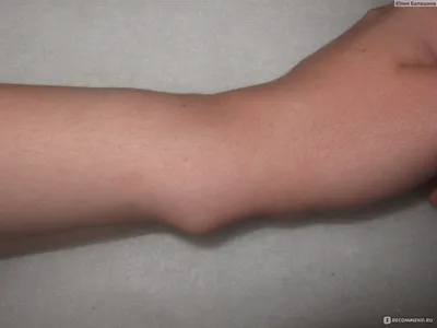 Фотография гигромы на кисти руки в макро