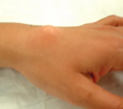 Гигрома на кисти руки - лечение народными средствами