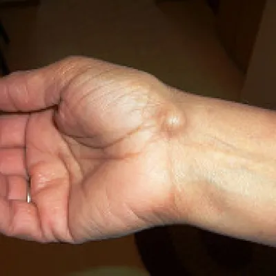 Фотография гигромы на кисти руки в ретро стиле