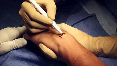 Гигрома на пальце руки: фото для операции