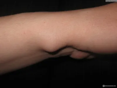 Изображение гигромы на пальце руки в формате монохрома