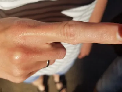 Гигрома на пальце руки: фотография в высоком разрешении