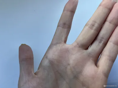 Картинка гигромы на пальце руки в формате WebP