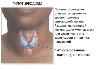 Гипотиреоз у подростков.