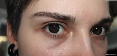 Фотография Глаза Наркомана: последствия наркомании для здоровья глаз