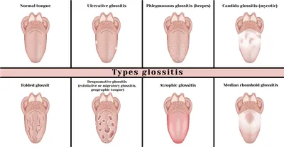 Ромбовидный глоссит — признаки, фото, лечение, уход за языком в статье  Startsmile.ru