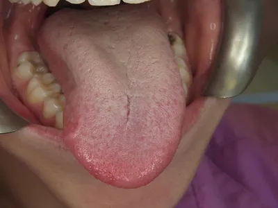 Глоссит языка: лечение, причины, препараты от глоссита