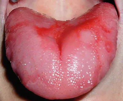 Кандидозный глоссит языка — симптомы и лечение