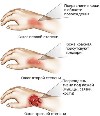 Фото гнойничков на руках для обучения студентов-медиков