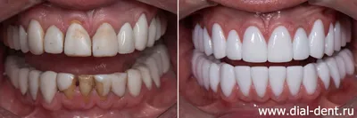 Голливудская улыбка | Клиника биоэстетической стоматологии доктора Даяна