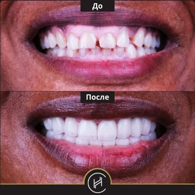 Голливудская улыбка - Стоматология Москвы \"Королевская Улыбка\"