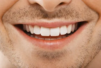 Как сделать голливудскую улыбку? 3 самых популярных способа на примерах  звезд - Центр эстетической медицины Консул-ST Нижний Тагил