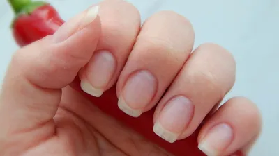 Фотография грибка на ногтях рук на указательном пальце