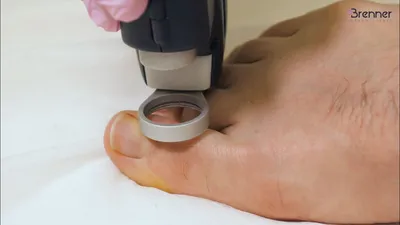 Изображение грибка на ногтях рук у пациента с диабетом