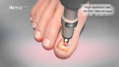 Фото грибка на ногтях рук: как избежать повторной инфекции