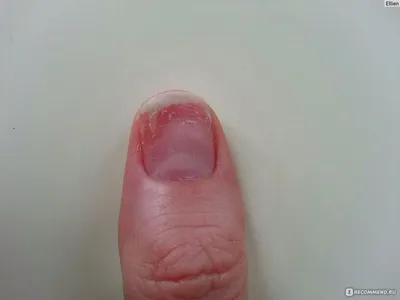 Картинка грибка на ногтях рук на мизинце