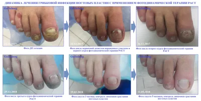 Изображение грибка ногтей рук с подписью о симптомах